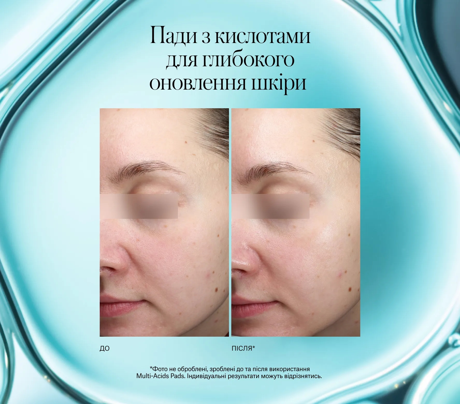 Resurfacing Multi-Acids Pads Next-Gen